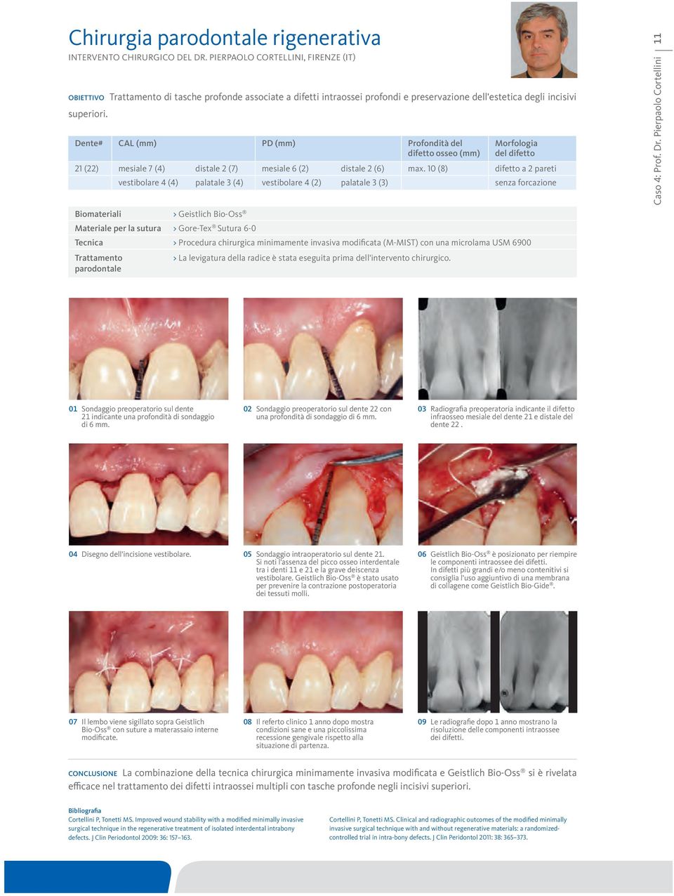 Dente# CAL (mm) PD (mm) Profondità del Morfologia del difetto 21 (22) mesiale 7 (4) distale 2 (7) mesiale 6 (2) distale 2 (6) max.