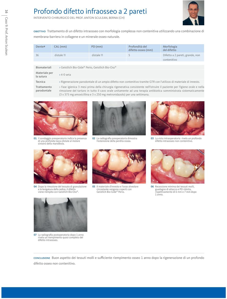 Dente# CAL (mm) PD (mm) Profondità del Morfologia del difetto 36 distale 11 distale 11 5 Difetto a 2 pareti, grande, non contenitivo Biomateriali > Geistlich Bio-Gide Perio, Geistlich Bio-Oss