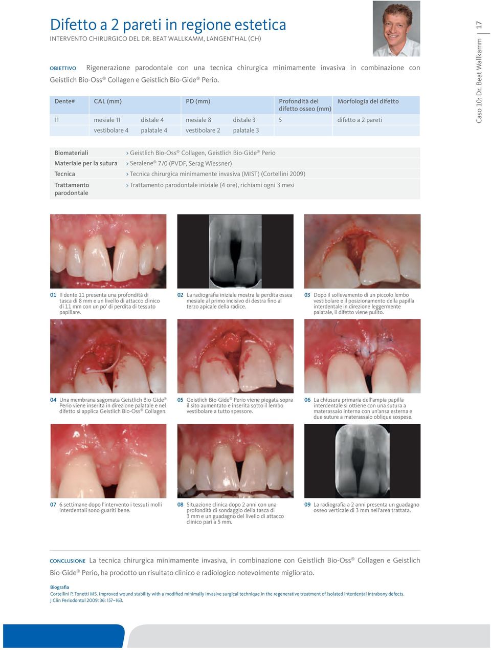 Dente# CAL (mm) PD (mm) Profondità del Morfologia del difetto 11 mesiale 11 distale 4 mesiale 8 distale 3 5 difetto a 2 pareti vestibolare 4 palatale 4 vestibolare 2 palatale 3 Caso 10: Dr.