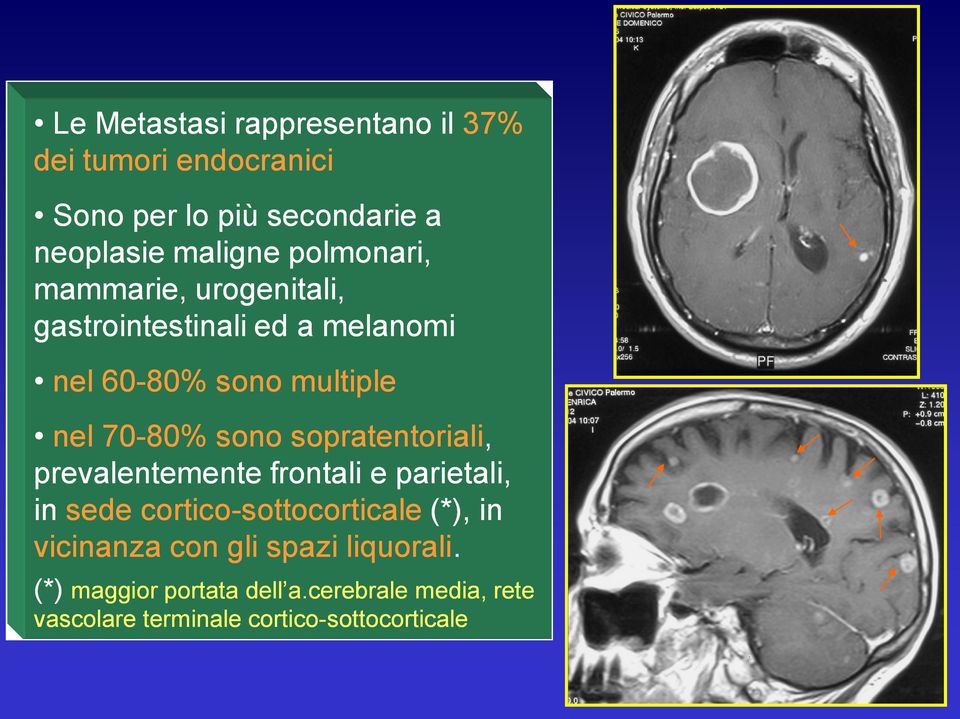 sopratentoriali, prevalentemente frontali e parietali, in sede cortico-sottocorticale (*), in vicinanza con