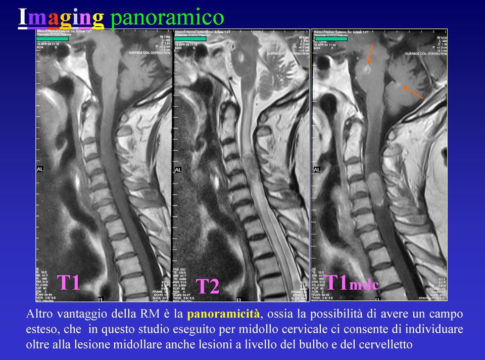 che in questo studio eseguito per midollo cervicale ci consente di
