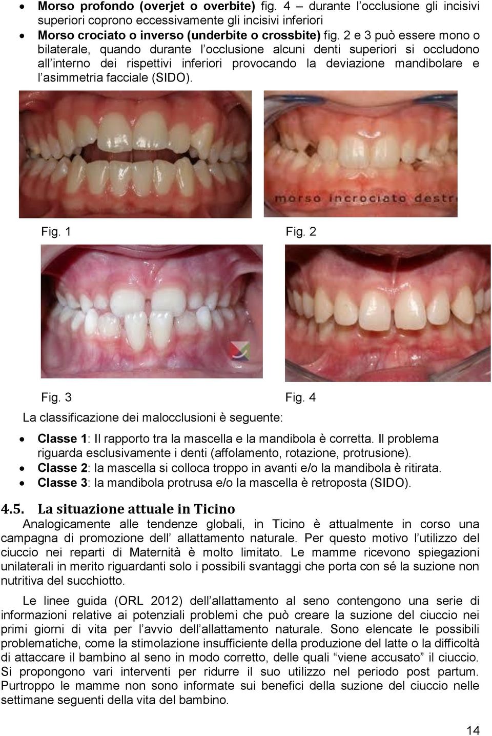 (SIDO). Fig. 1 Fig. 2 Fig. 3 Fig. 4 La classificazione dei malocclusioni è seguente: Classe 1: Il rapporto tra la mascella e la mandibola è corretta.