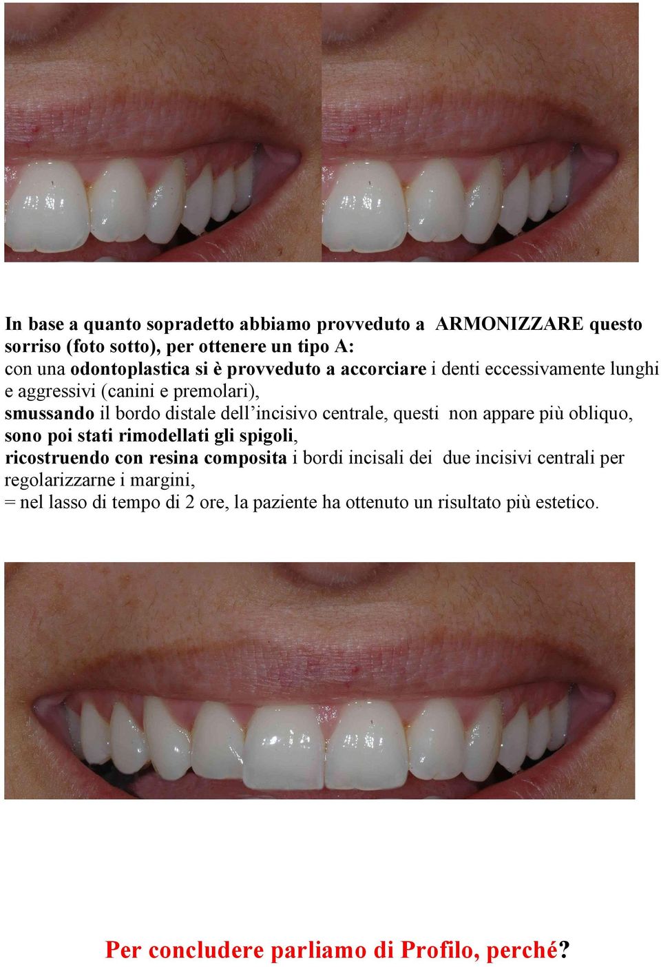 non appare più obliquo, sono poi stati rimodellati gli spigoli, ricostruendo con resina composita i bordi incisali dei due incisivi centrali per