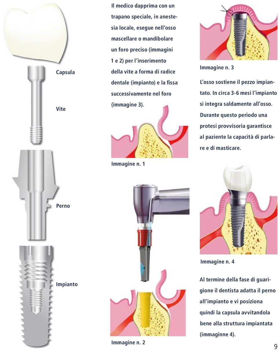 In circa 3-6 mesi l impianto si integra saldamente all osso. Durante questo periodo una protesi provvisoria garantisce al paziente la capacità di parlare e di masticare.