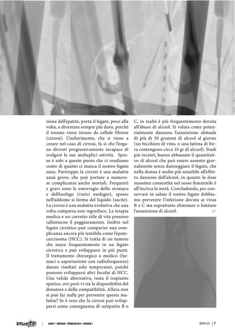 Spesso è solo a questo punto che ci rendiamo conto di quanto ci manca il nostro fegato sano. Purtroppo la cirrosi è una malattia assai grave, che può portare a numerose complicanze anche mortali.