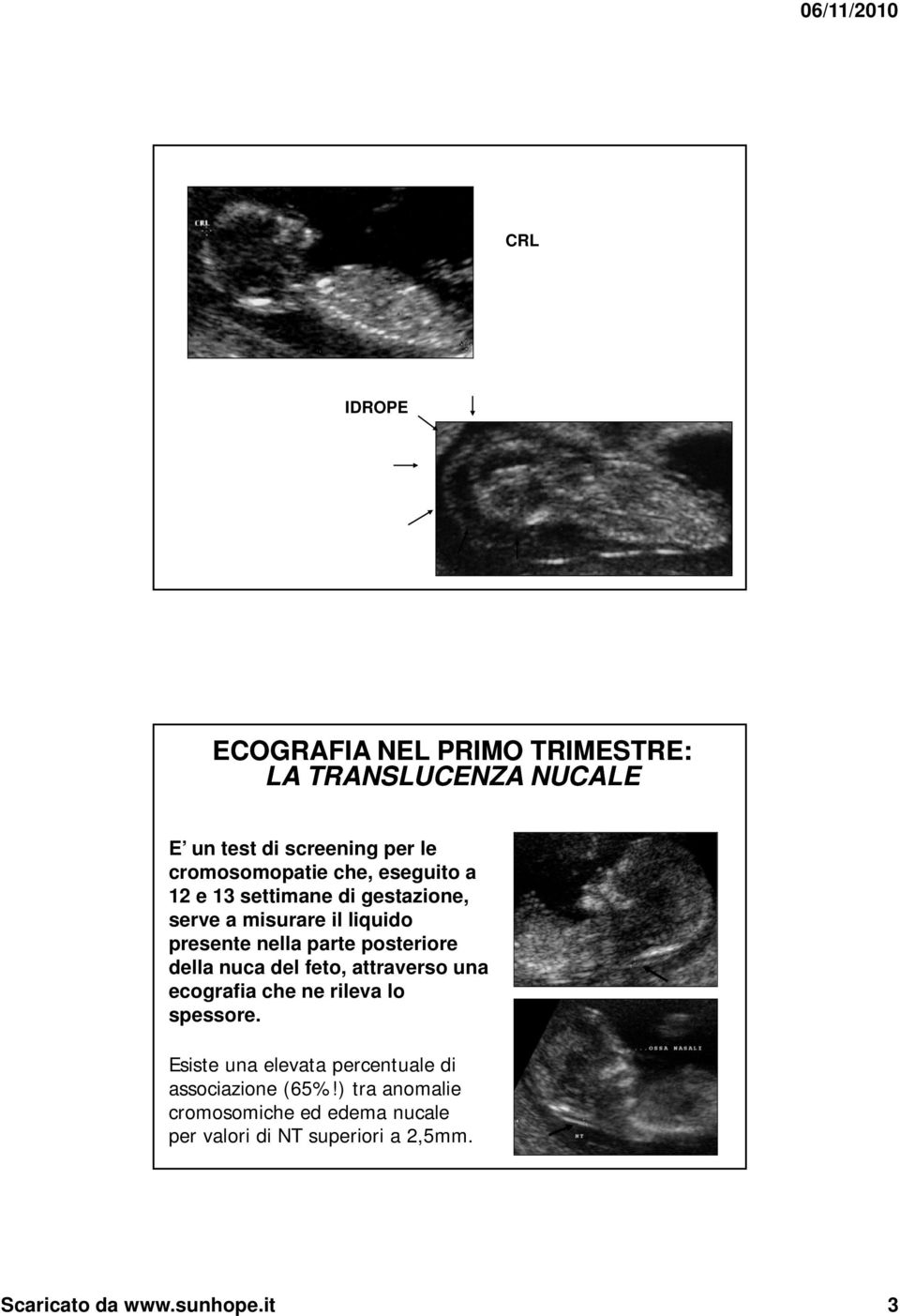 della nuca del feto, attraverso una ecografia che ne rileva lo spessore.