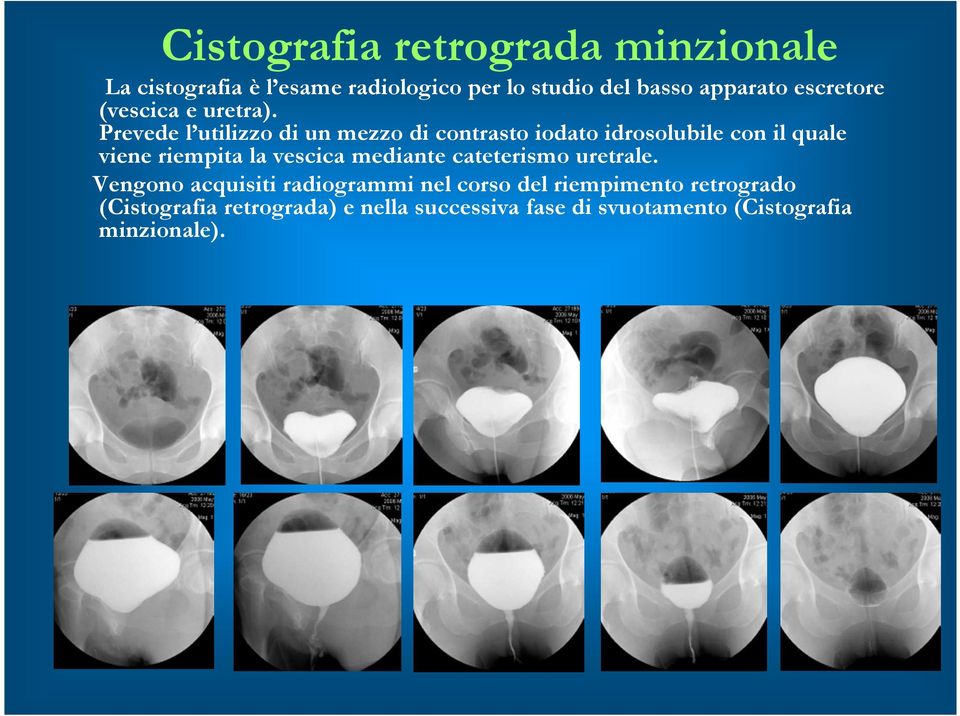 Prevede l utilizzo di un mezzo di contrasto iodato idrosolubile con il quale viene riempita la vescica