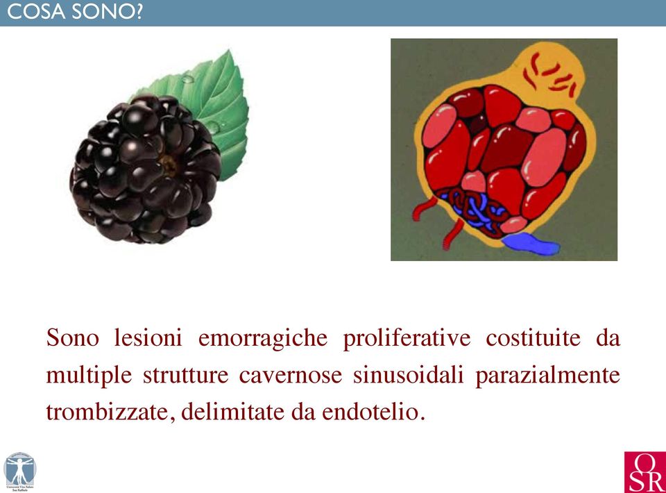 proliferative costituite da multiple