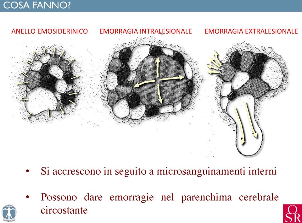 INTRALESIONALE EMORRAGIA EXTRALESIONALE Si