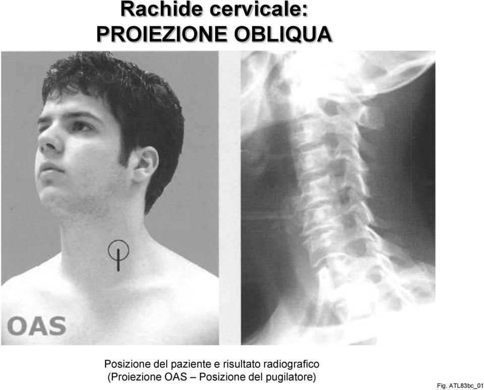 radiografico (Proiezione OAS