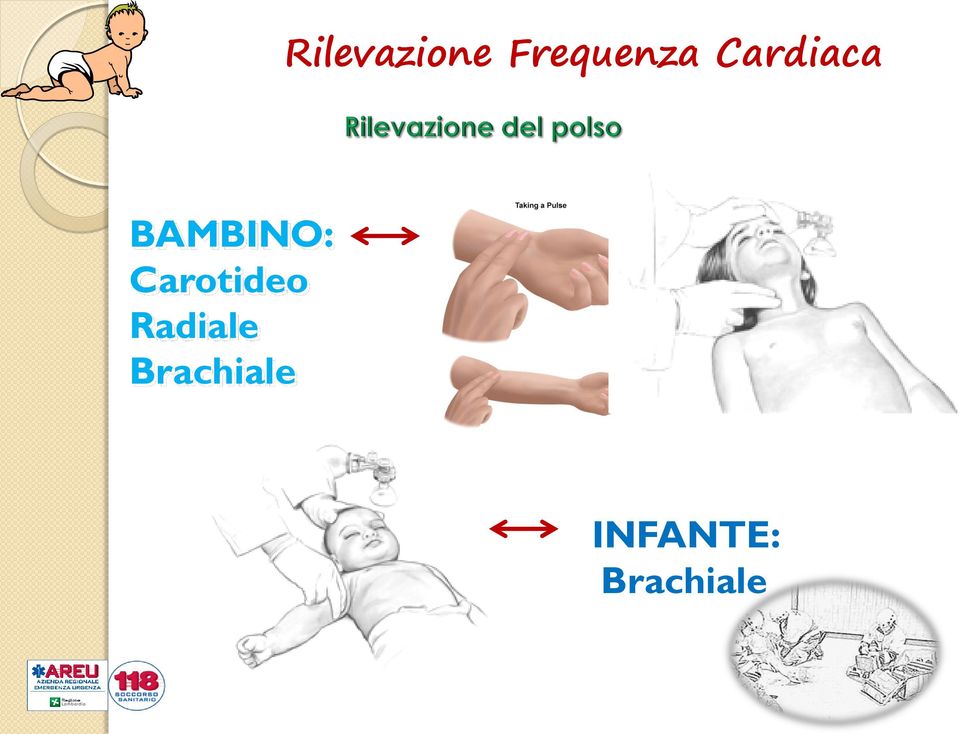 Carotideo Radiale