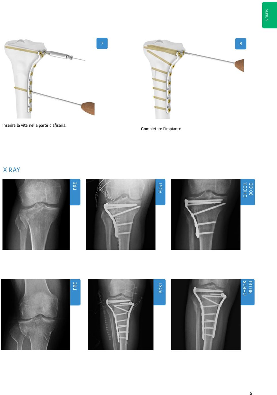 Completare l impianto X RAY