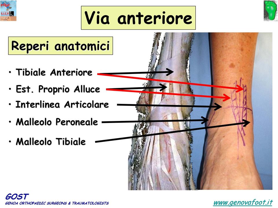 Proprio Alluce Interlinea