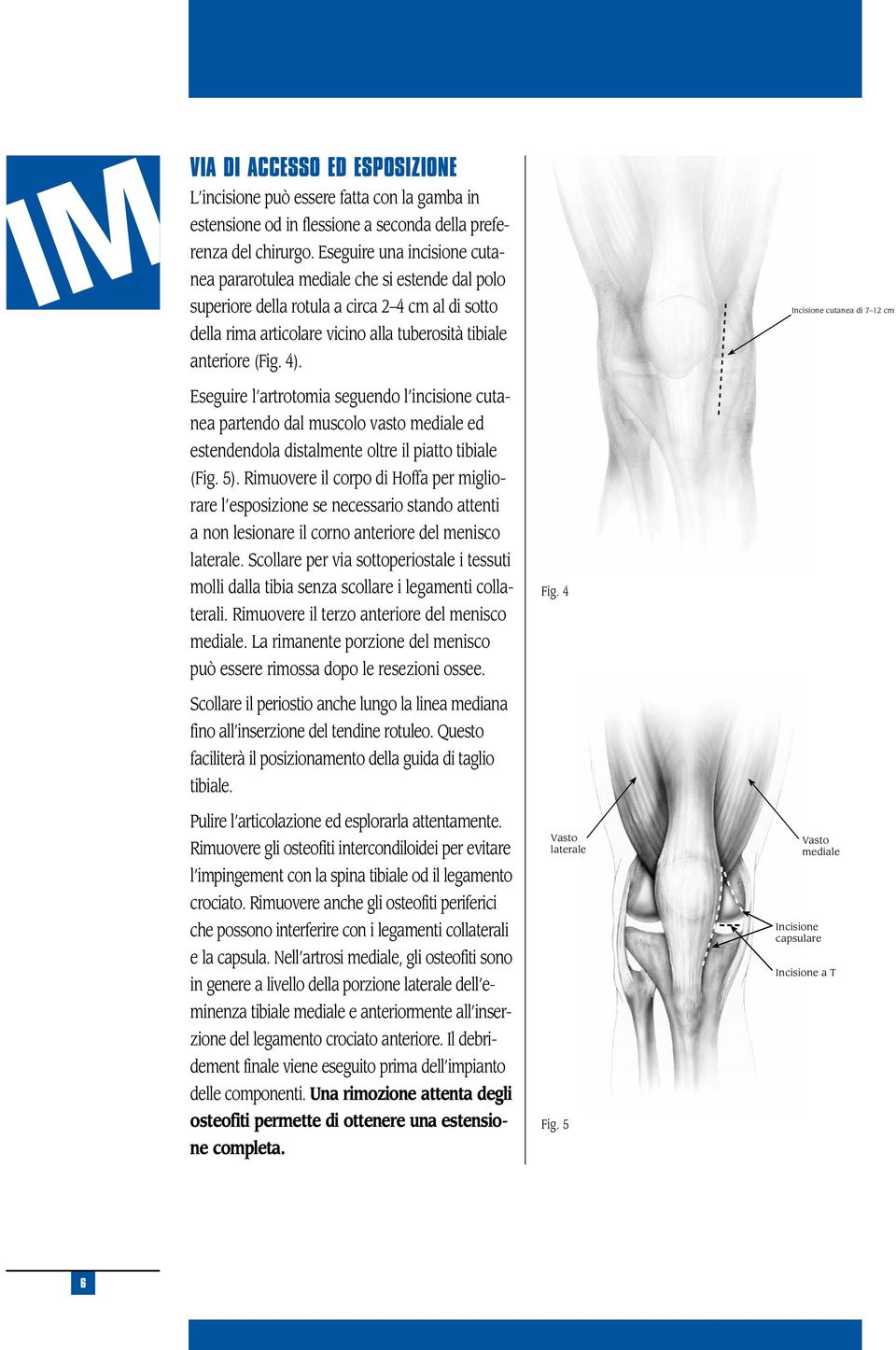 Incisione cutanea di 7 12 cm Eseguire l artrotomia seguendo l incisione cutanea partendo dal muscolo vasto mediale ed estendendola distalmente oltre il piatto tibiale (Fig. 5).