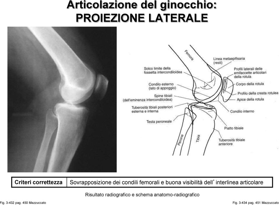 visibilità dell interlinea articolare Risultato radiografico e