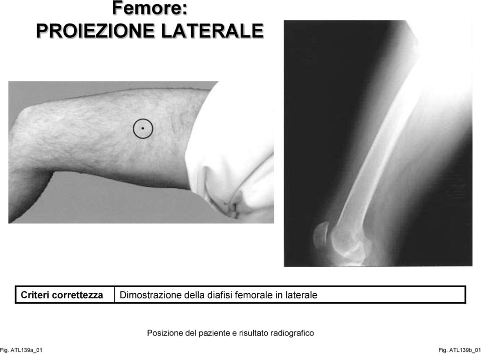 femorale in laterale Posizione del paziente