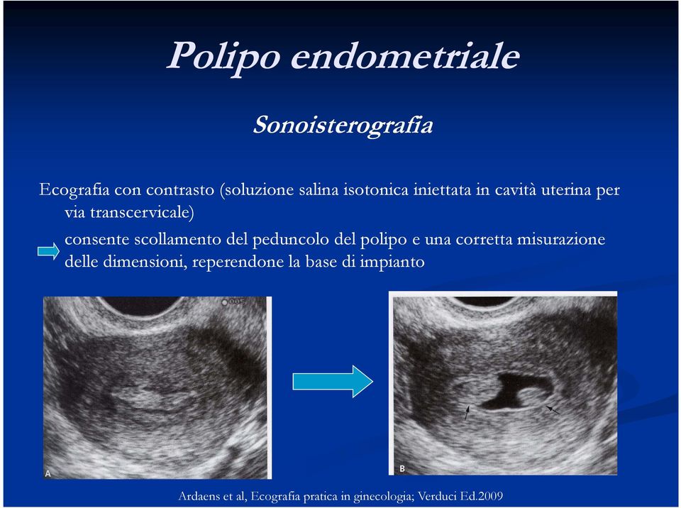 scollamento del peduncolo del polipo e una corretta misurazione delle dimensioni,