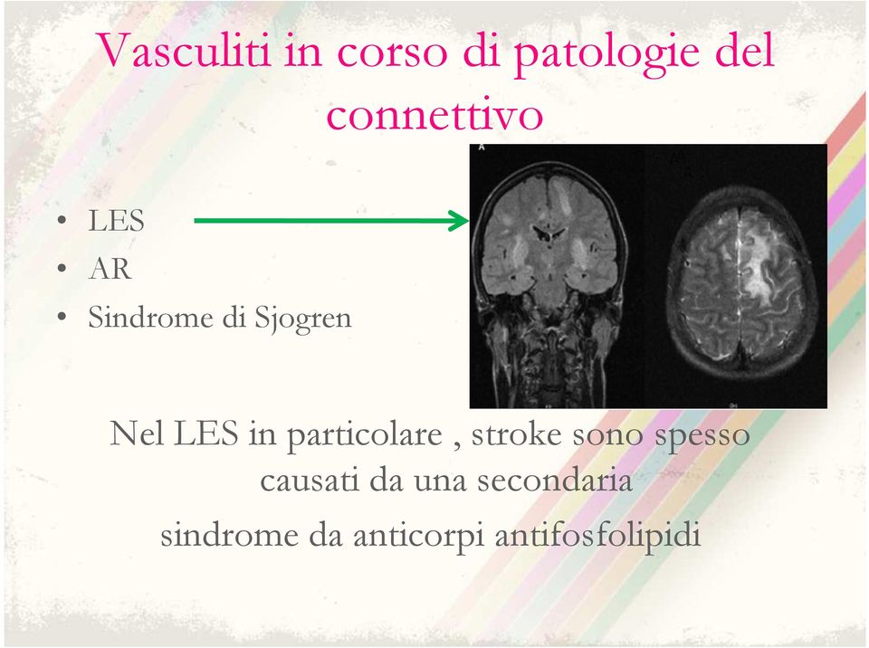 LES in particolare, stroke sono spesso