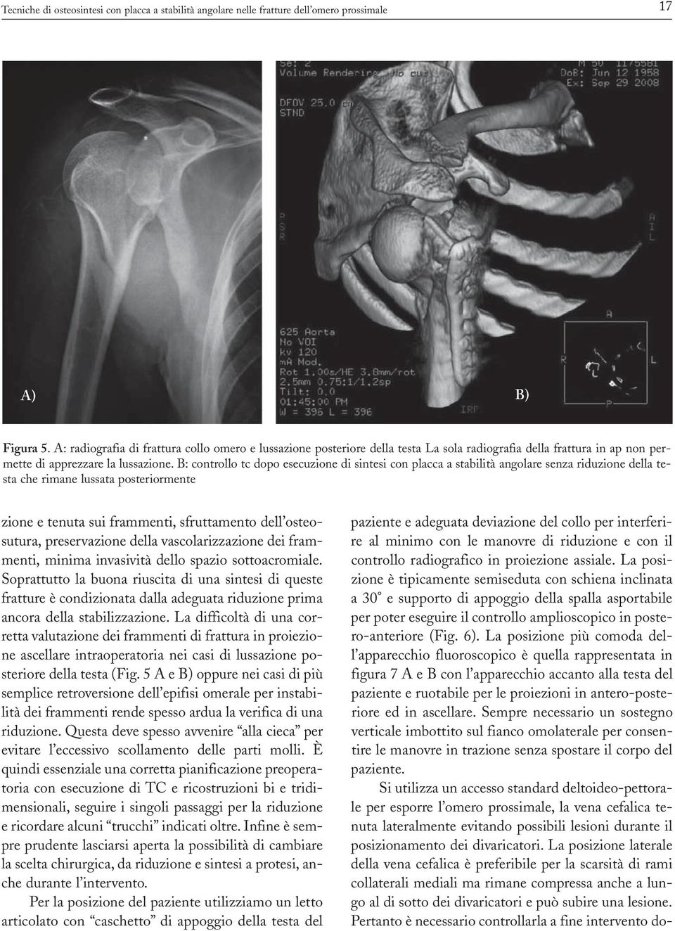 B: controllo tc dopo esecuzione di sintesi con placca a stabilità angolare senza riduzione della testa che rimane lussata posteriormente zione e tenuta sui frammenti, sfruttamento dell osteosutura,