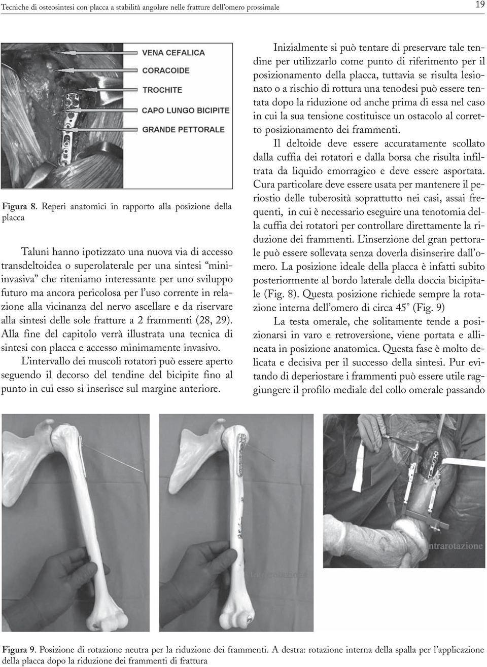 uno sviluppo futuro ma ancora pericolosa per l uso corrente in relazione alla vicinanza del nervo ascellare e da riservare alla sintesi delle sole fratture a 2 frammenti (28, 29).