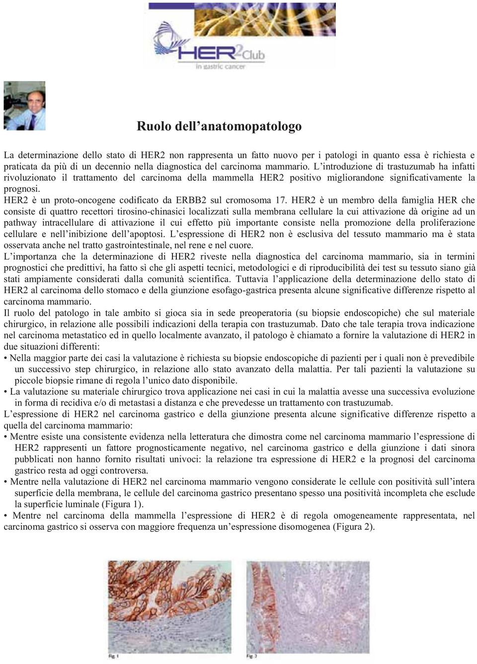 HER2 è un proto-oncogene codificato da ERBB2 sul cromosoma 17.