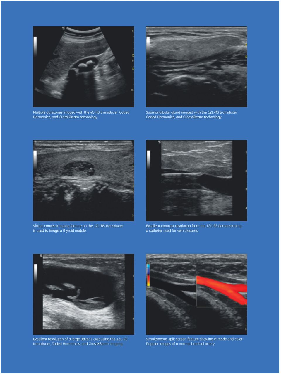 Virtual convex imaging feature on the 12L-RS transducer is used to image a thyroid nodule.