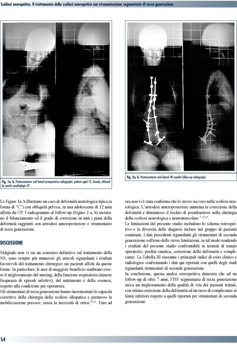 Le Figure a, b illustrano un caso di deformità neurologica tipica (a forma di C ) con obliquità pelvica, in una adolescente di 2 anni affetta da CP.