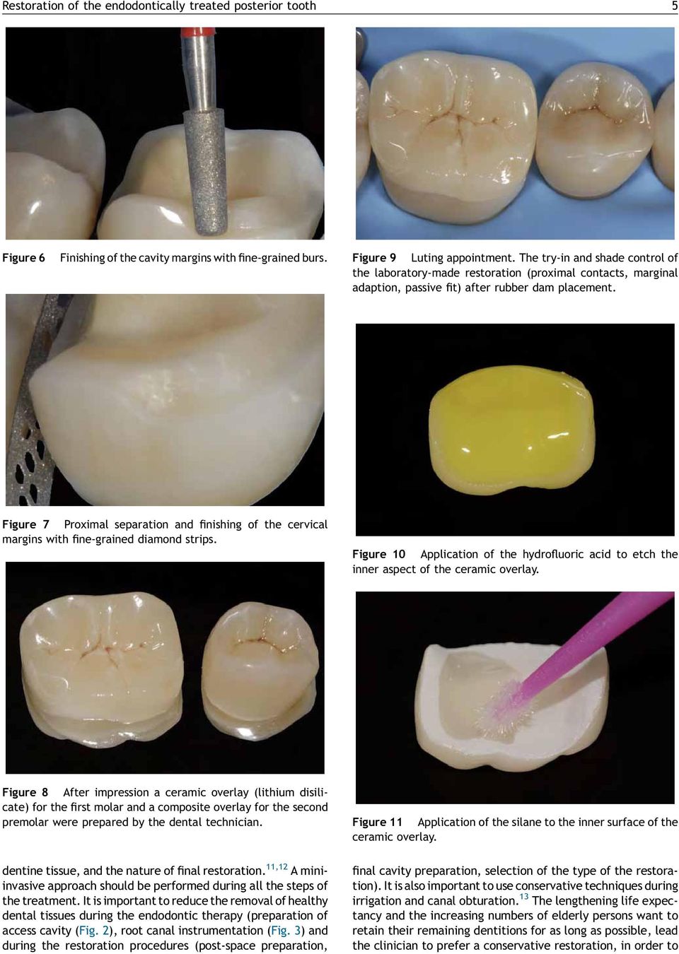 Figure 7 Proximal separation and finishing of the cervical margins with fine-grained diamond strips. Figure 10 Application of the hydrofluoric acid to etch the inner aspect of the ceramic overlay.