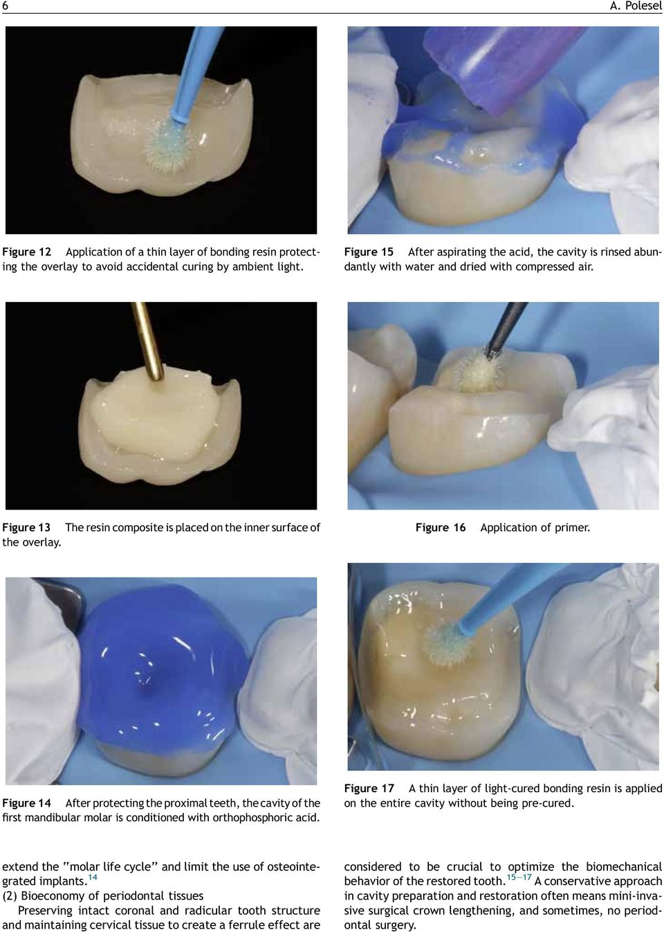 Figure 16 Application of primer. Figure 14 After protecting the proximal teeth, the cavity of the first mandibular molar is conditioned with orthophosphoric acid.