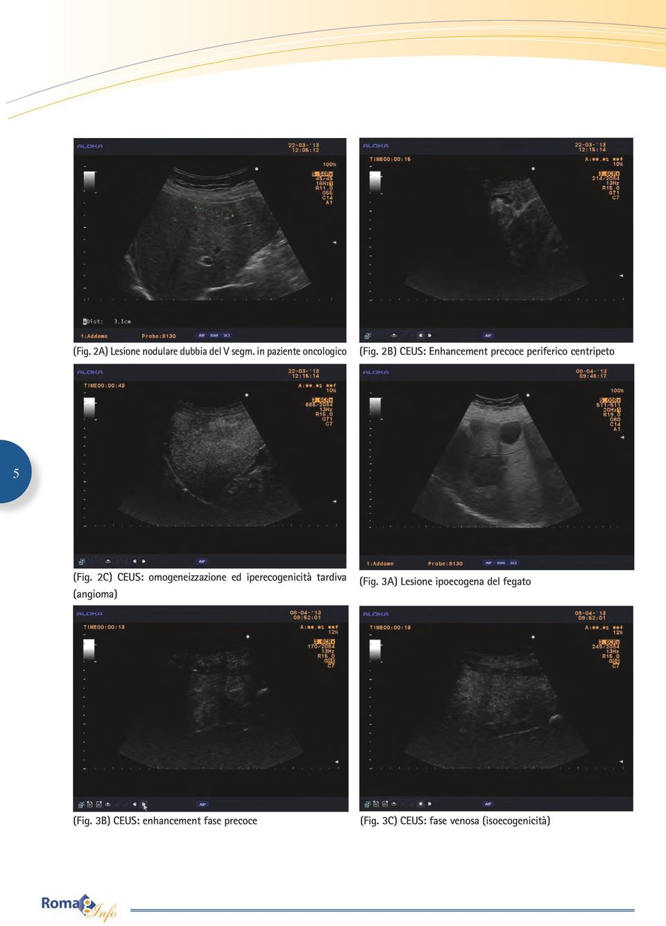 2C) CEUS: omogeneizzazione ed iperecogenicità tardiva (Fig.