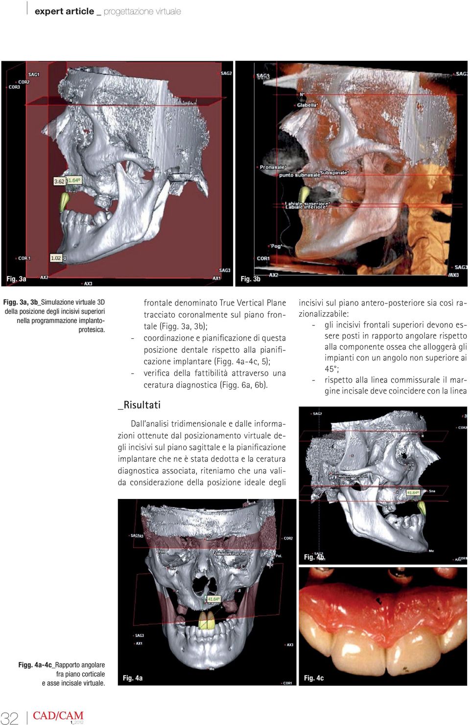 3a, 3b); - coordinazione e pianificazione di questa posizione dentale rispetto alla pianificazione implantare (Figg. 4a-4c, 5); - verifica della fattibilità attraverso una ceratura diagnostica (Figg.