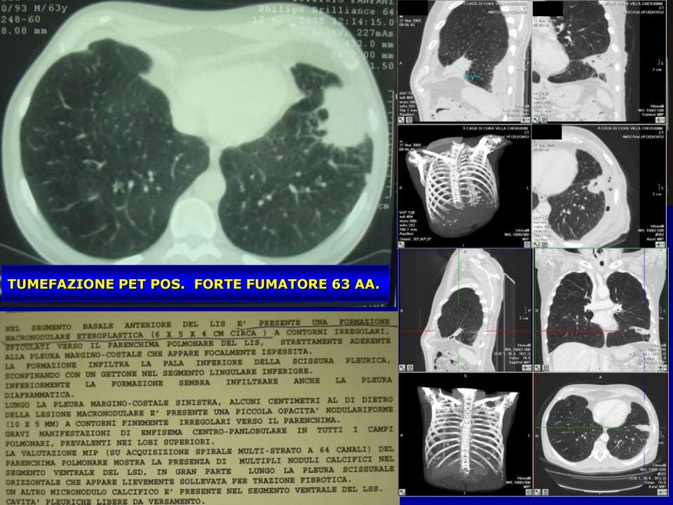 lepidica) componente endobronchiale pleural tag disomogeneità (necrosi)