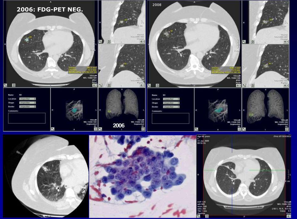 calcificazioni centrali, diffuse, laminari o a pop corn c.e. < 15 U.H.