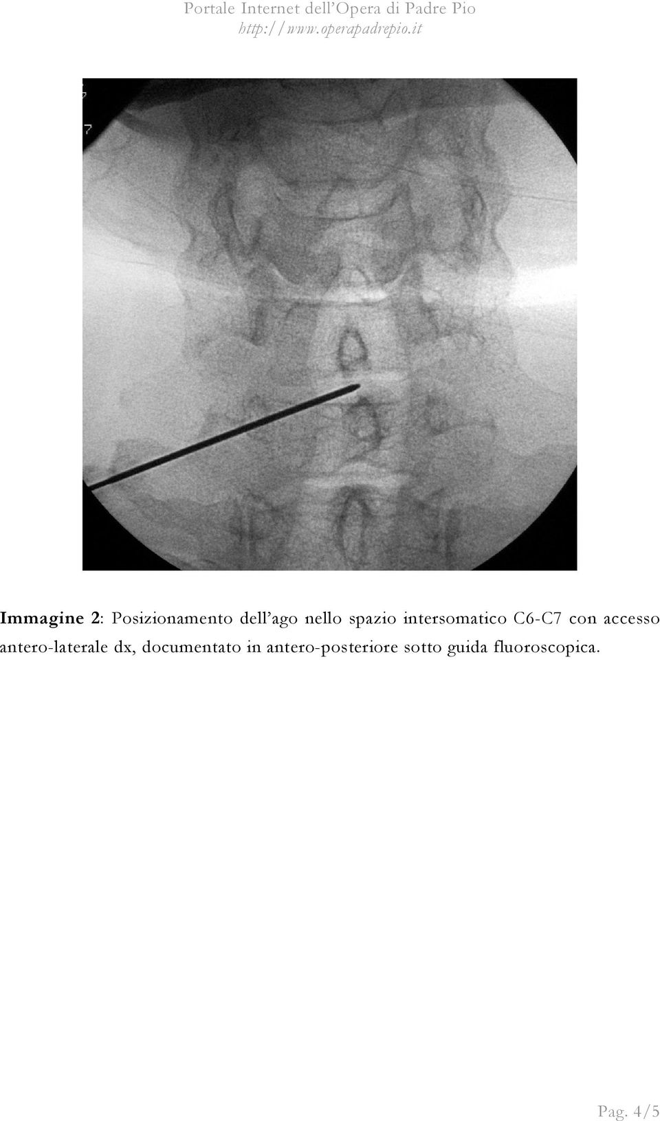 antero-laterale dx, documentato in