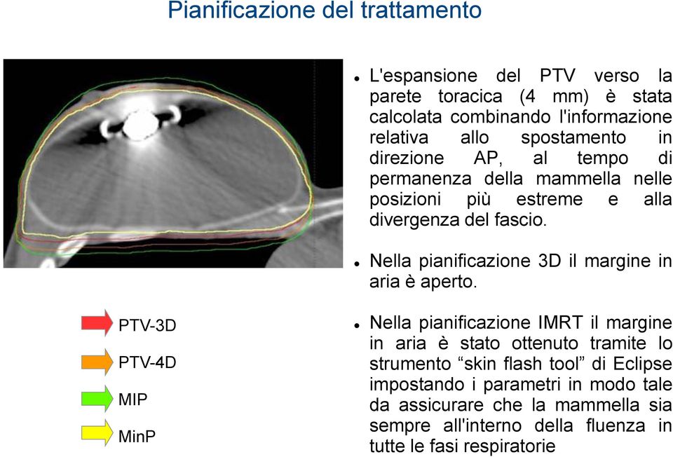 Nella pianificazione 3D il margine in aria è aperto.