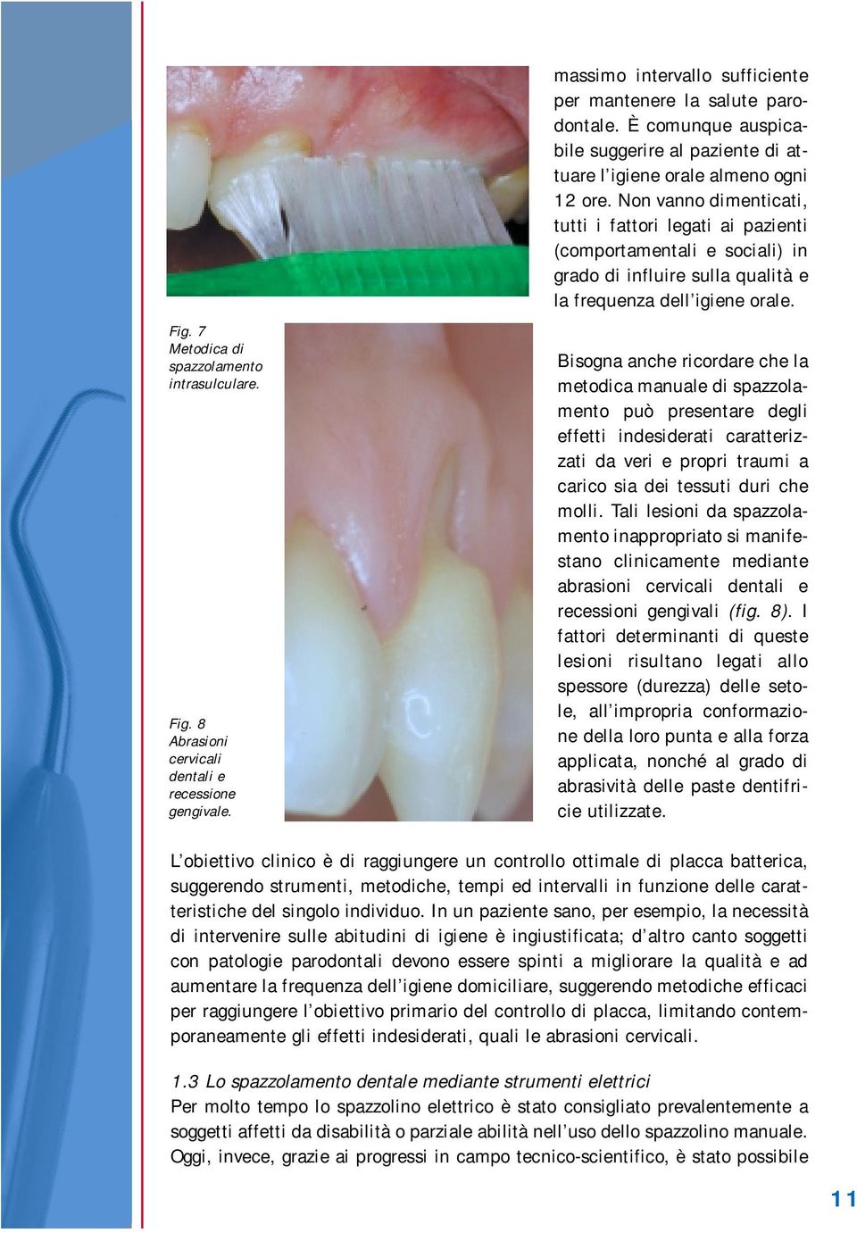 7 Metodica di spazzolamento intrasulculare. Fig. 8 Abrasioni cervicali dentali e recessione gengivale.