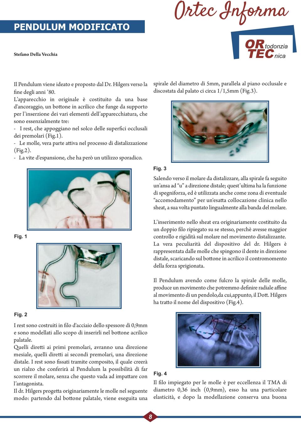 I rest, che appoggiano nel solco delle superfici occlusali dei premolari (Fig.1). - Le molle, vera parte attiva nel processo di distalizzazione (Fig.2).