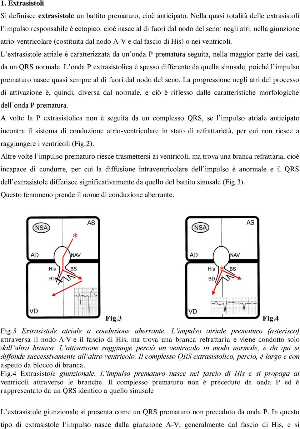 fascio di His) o nei ventricoli. L extrasistole atriale è caratterizzata da un onda P prematura seguita, nella maggior parte dei casi, da un QRS normale.