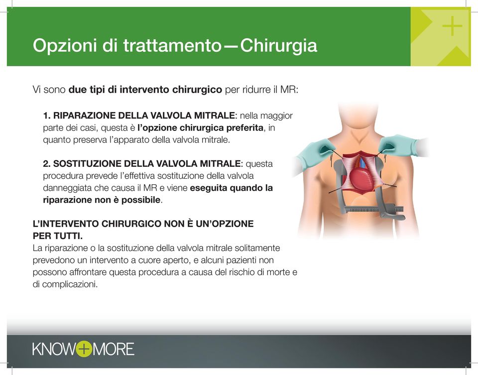 SOSTITUZIONE DELLA VALVOLA MITRALE: questa procedura prevede l effettiva sostituzione della valvola danneggiata che causa il MR e viene eseguita quando la riparazione non è