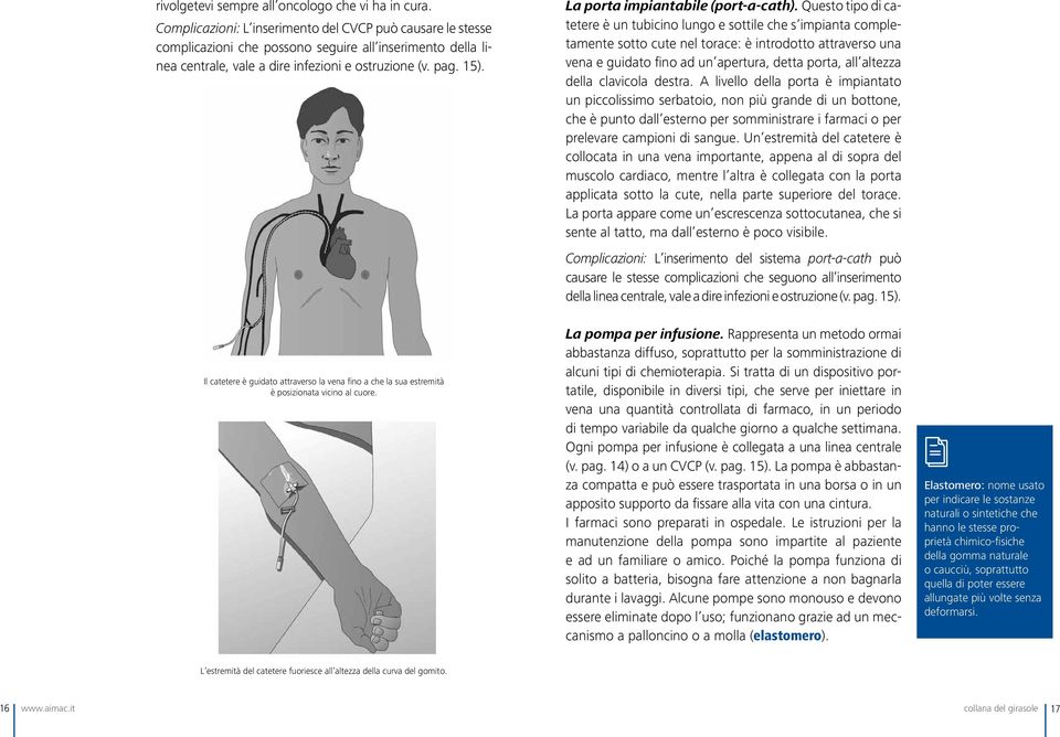 Il catetere è guidato attraverso la vena fino a che la sua estremità è posizionata vicino al cuore. La porta impiantabile (port-a-cath).