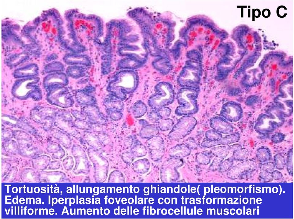 Iperplasia foveolare con