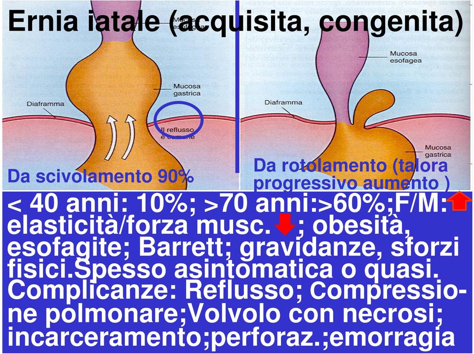 ; obesità, esofagite; Barrett; gravidanze, sforzi fisici.spesso asintomatica o quasi.