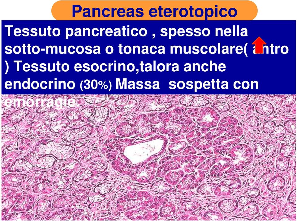 muscolare( antro ) Tessuto esocrino,talora