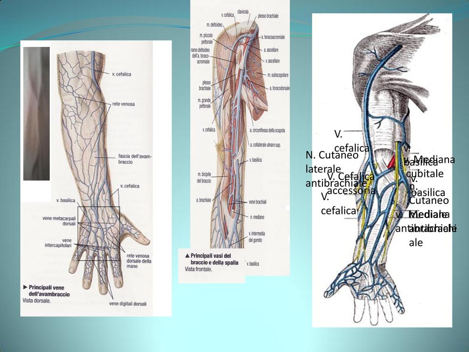 cefalica v. v. basilica Mediana cubitale v.