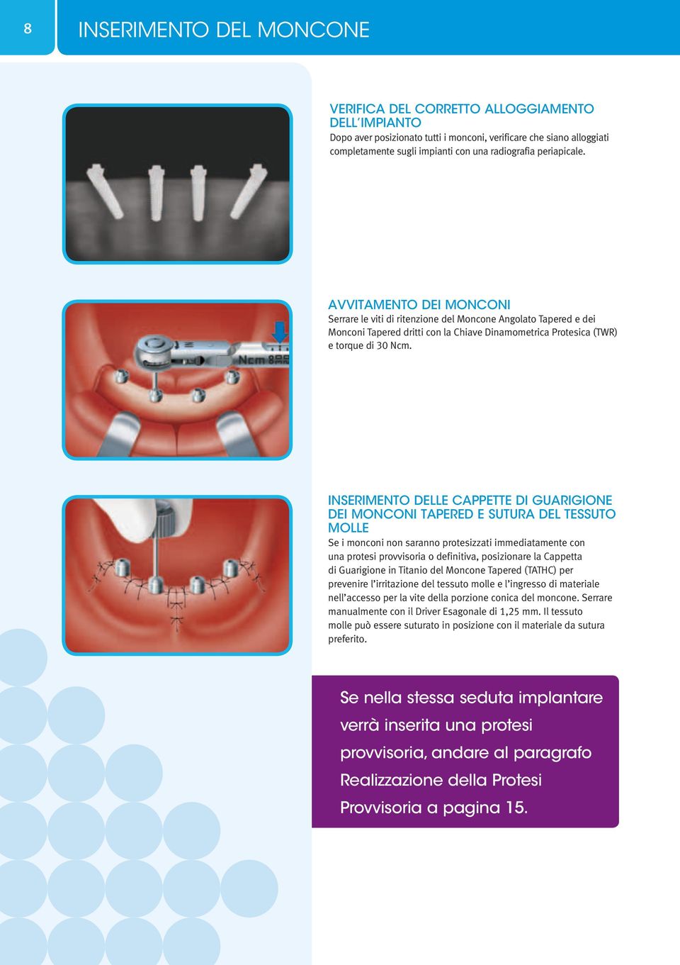 INSERIMENTO DELLE CAPPETTE DI GUARIGIONE DEI MONCONI TAPERED E SUTURA DEL TESSUTO MOLLE Se i monconi non saranno protesizzati immediatamente con una protesi provvisoria o definitiva, posizionare la