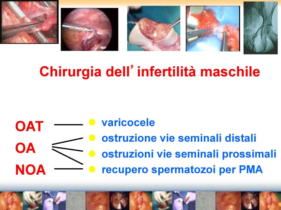 seminali distali " ostruzioni vie