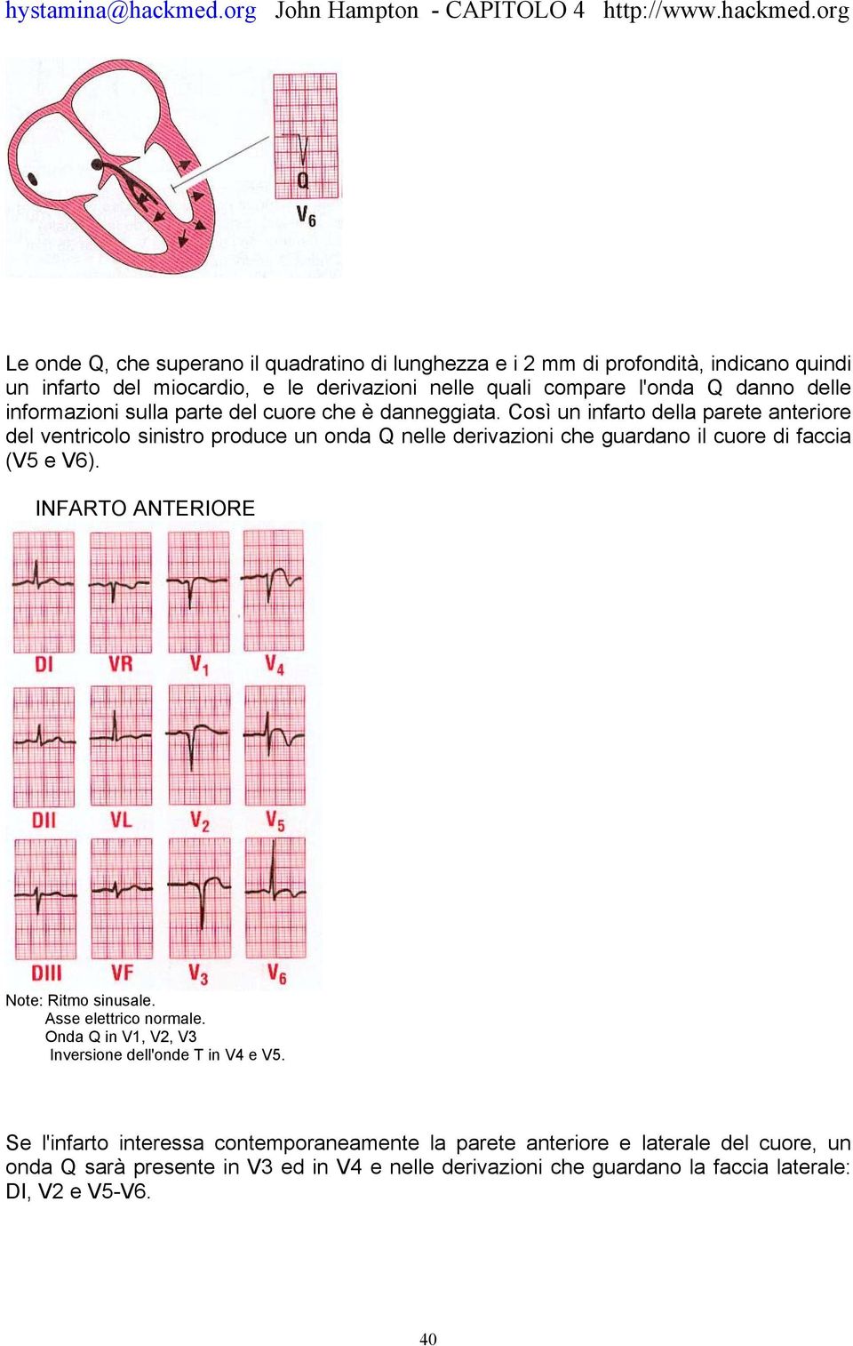 Così un infarto della parete anteriore del ventricolo sinistro produce un onda Q nelle derivazioni che guardano il cuore di faccia (V5 e V6).