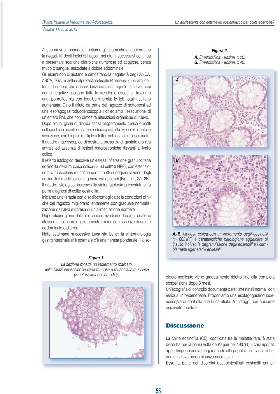 A.-B. Mucosa colica con un incremento degli eosinofili (> 60/HPF) e caratteristiche patologiche aggiuntive di insulto incluso la degranulazione degli eosinofili e i cambiamenti rigenerativi