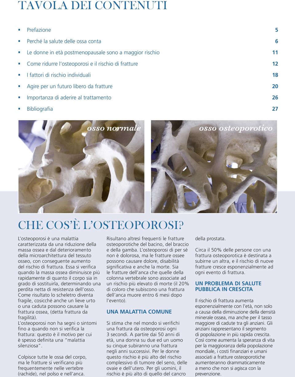 L osteoporosi è una malattia caratterizzata da una riduzione della massa ossea e dal deterioramento della microarchitettura del tessuto osseo, con conseguente aumento del rischio di frattura.