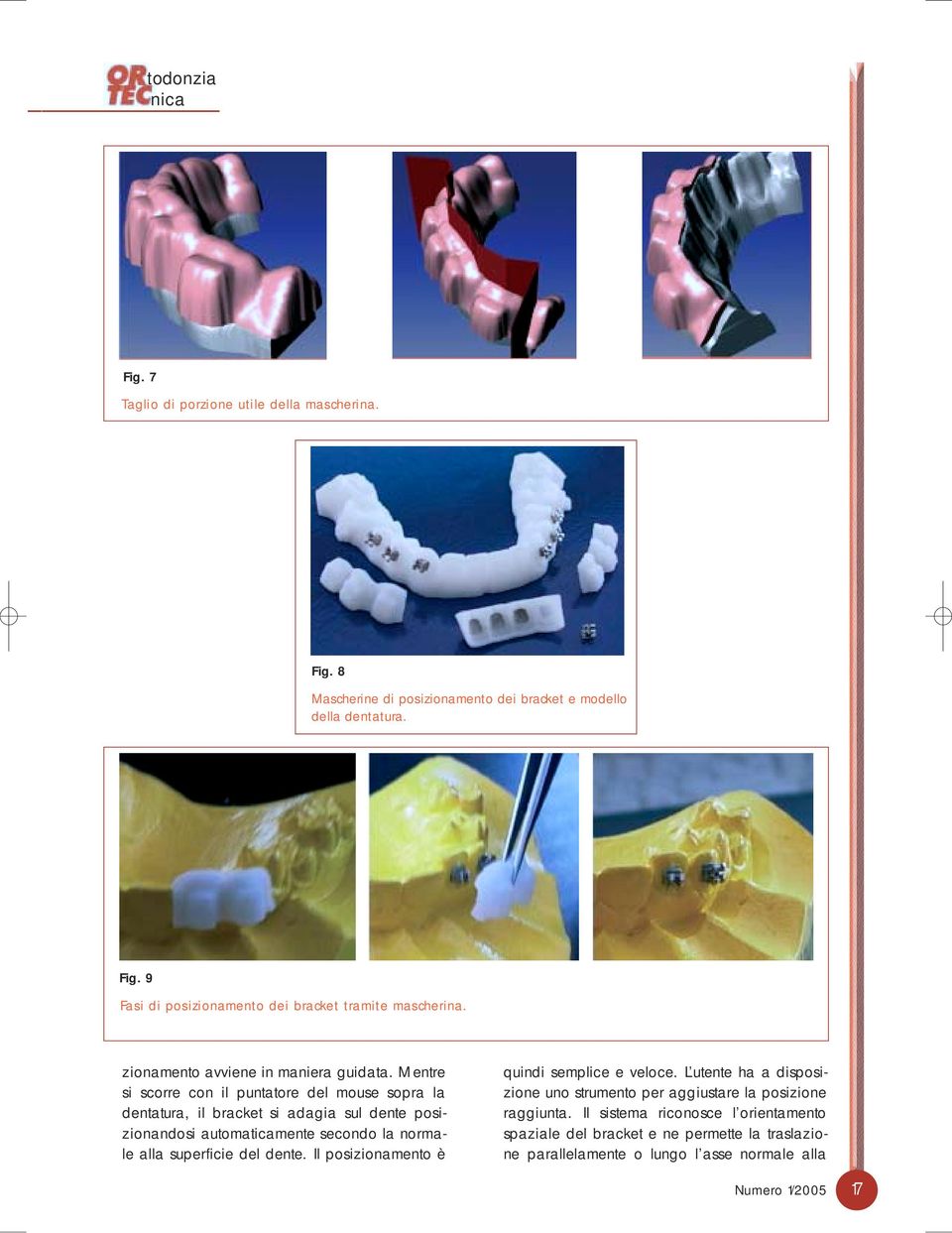 Mentre si scorre con il puntatore del mouse sopra la dentatura, il bracket si adagia sul dente posizionandosi automaticamente secondo la normale alla superficie